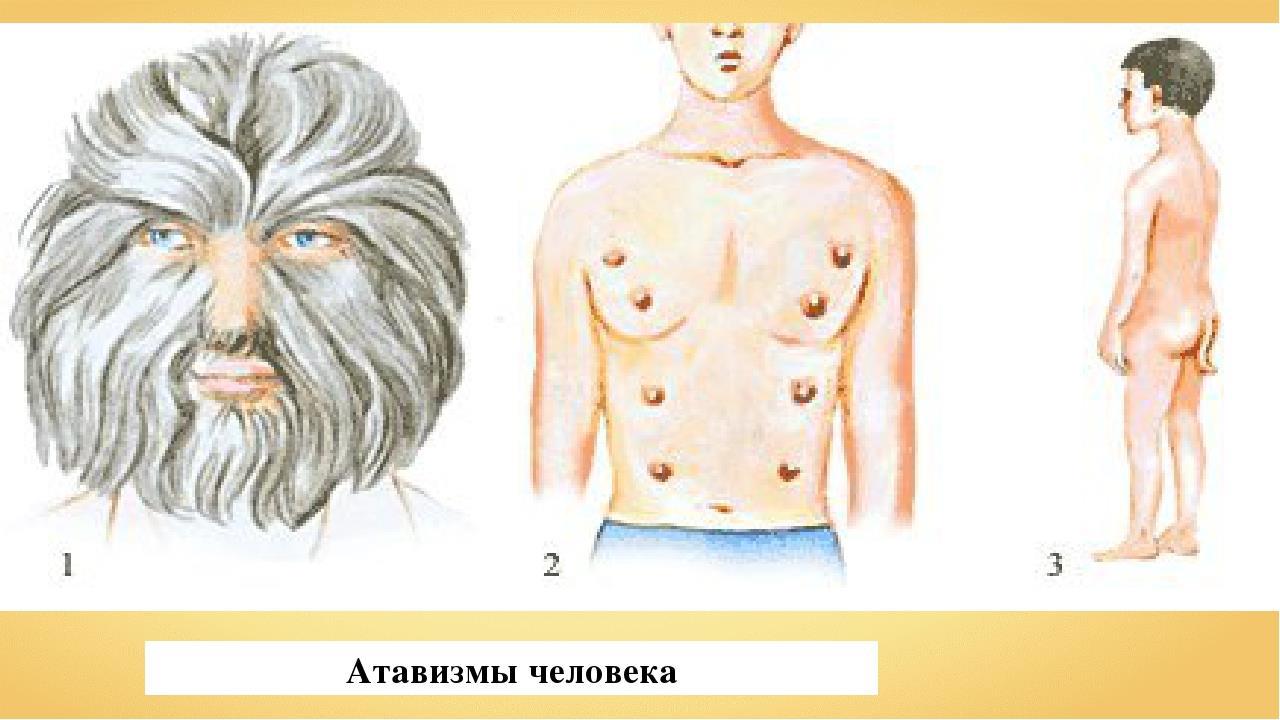 Атавизмы у человека. Атавизмы у человека многососковость. Волосяной Покров рудимент. Рудименты человека многососковость. Атавизмы и рудименты человека.